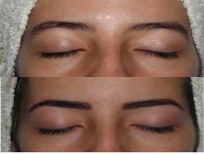 antes e depois